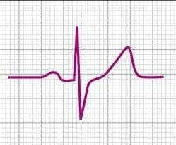 qrs isodifasico qrs isodifasico
