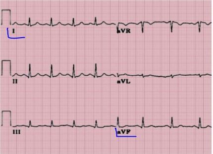 EKG - Eje Cardíaco 
