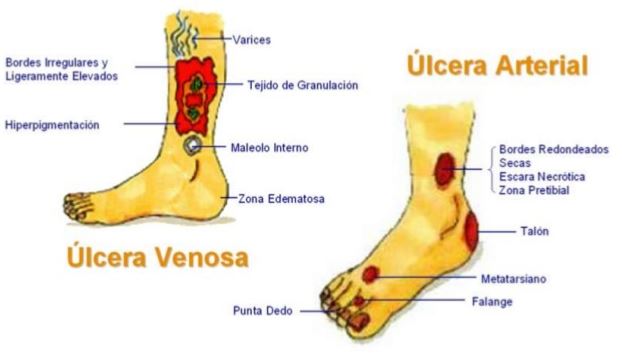 Insuficiencia Venosa