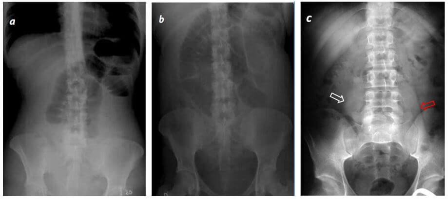 criterios ultrasonográficos de apendicitis